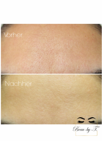 Microneedling